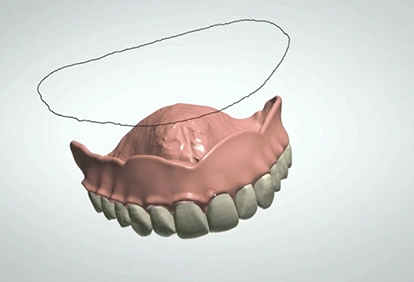 digital partial dentures