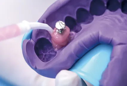 GumEasy™A-Silicona para máscara gingival: donde la precisión se encuentra con los estéticos en las restauraciones de implantes