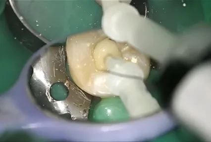 Reconstrucción confiable del muñón posterior con UltraCore: Caso clínico en el diente #37