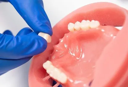 Costo del material del implante dental