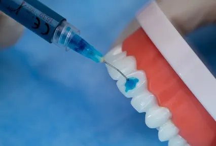 GEL GRABADOR DE ÁCIDO FOSFÓRICO AL 37% - GRANDE